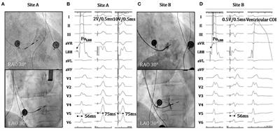 Case Report: Interventricular Septal Hematoma Complicating Left Bundle Branch Pacing Lead Implantation